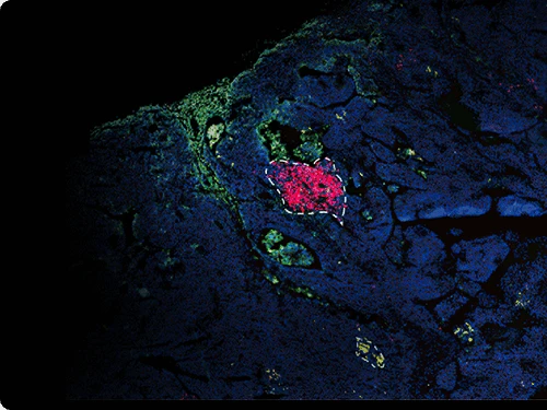 Disease Research - STOmics